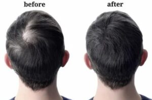 Hair Loss Treatment Ahmedabad