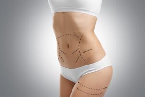 Fat Transfer in dubai