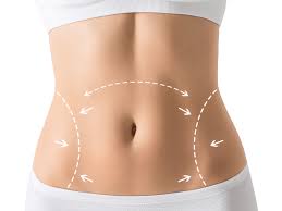 Can a Tummy Tuck Remove Stretch Marks and Loose Skin?