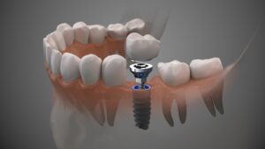 Comprehensive Guide to Implants Leeds AL: Understanding the Implant Procedure Leeds AL and Full Mouth Implant Leeds AL Solutions