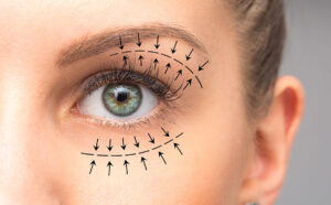 Discover the Benefits of Eyelid Surgery