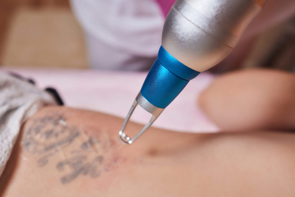 Does Laser Tattoo Removal Hurt More Than Getting Ink