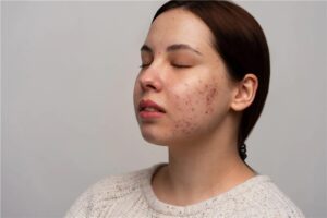 Does Laser Treatment Work for Acne Scars