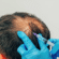Does PRP Hair Treatment Work for Baldness?