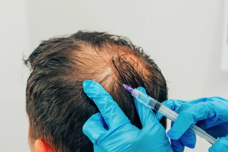 Does PRP Hair Treatment Work for Baldness?