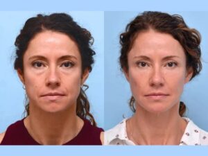How Thread Lift Treatments in Dubai Can Transform Your Look