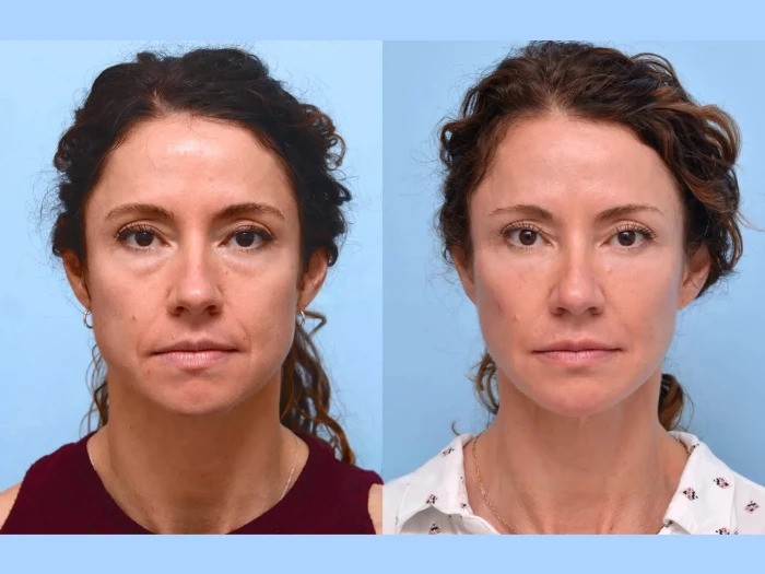 How Thread Lift Treatments in Dubai Can Transform Your Look