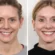 Thread Lift for Different Face Shapes: Insights from the Best Doctors in Dubai