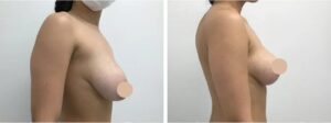 breast lift in dubai