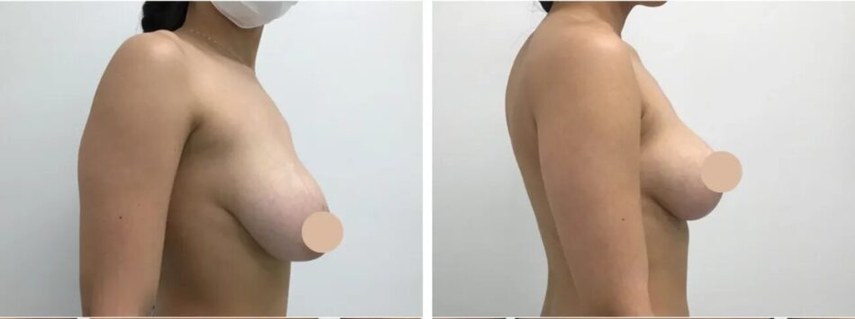 breast lift in dubai