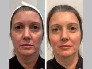 Experience Wrinkle Free Skin Through Thread Lift Guided by Best Doctors in Dubai