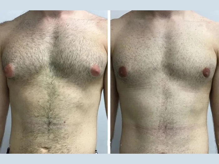 How the Best Gynecomastia Surgeon in Dubai Boosts Male Confidence
