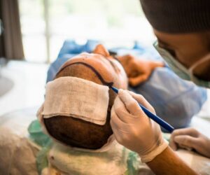 Hair Transplant in Islamabad