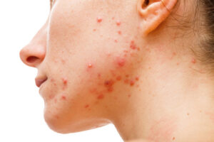 How Diet and Lifestyle Affect Acne Treatment