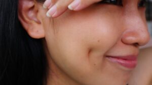 How Does Dimple Creation Surgery Work