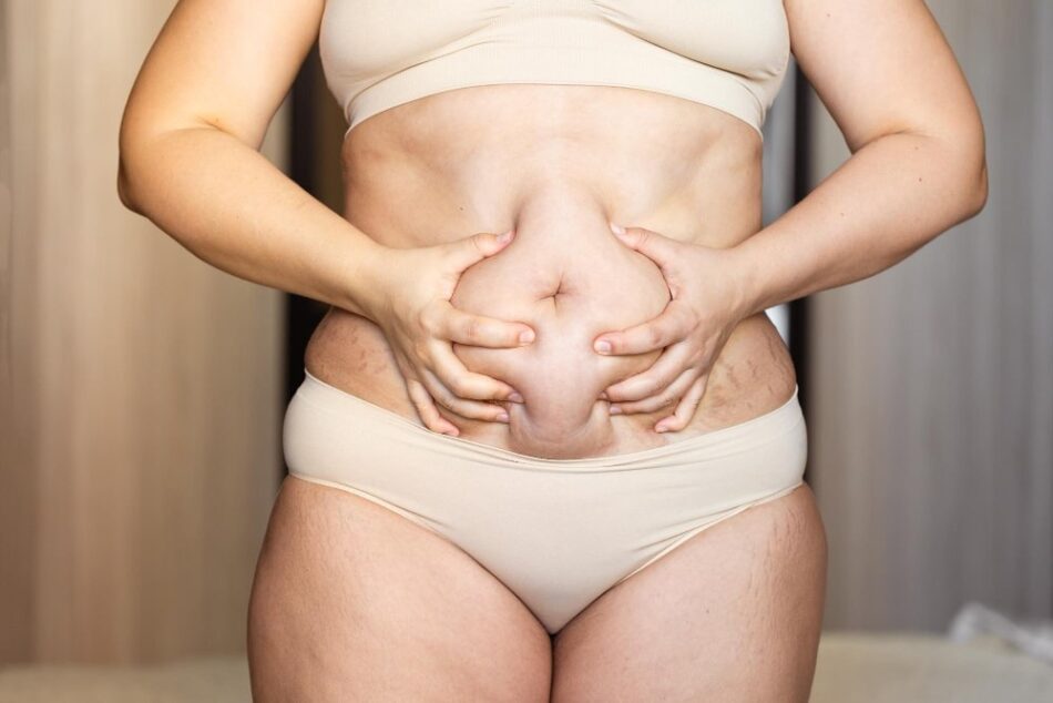 How Is Liposuction Surgery Different from CoolSculpting?