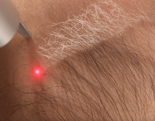 How Many Sessions Are Needed For Laser Hair Bleaching?