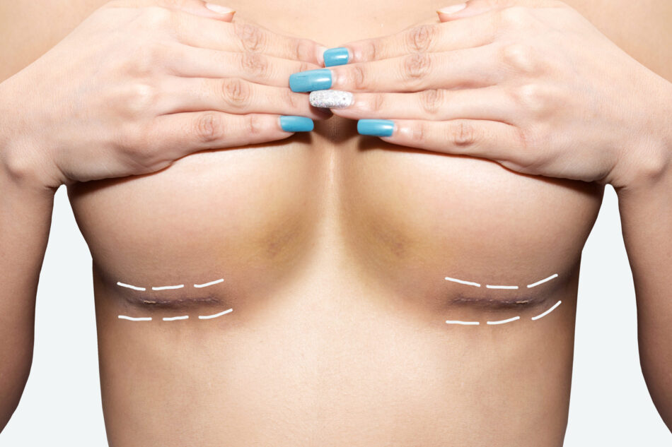 How Safe is Breast Lift Surgery