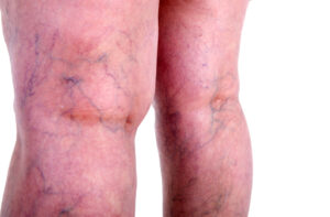 How Sclerotherapy Can Boost Your Confidence