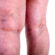 How Sclerotherapy Can Boost Your Confidence
