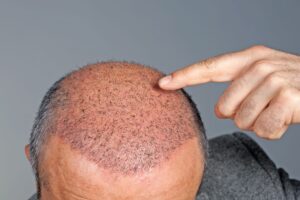 Is FUE Hair Transplant Worth the Long-Term Investment