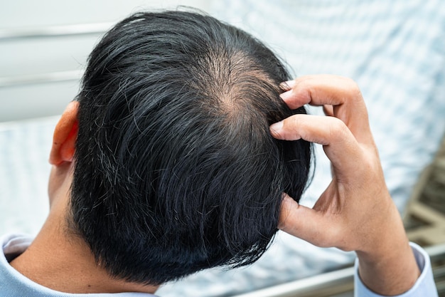 Is Hair Transplant Cost Higher for Crown Area