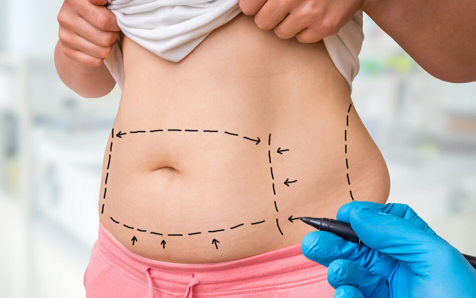 Liposuction Surgery Simple Way to Slim Down