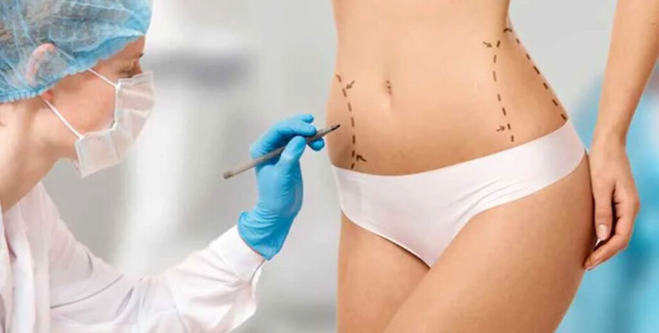 Liposuction in Islamabad