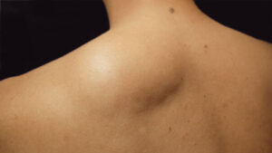 Minimizing Scarring After Lipoma Removal