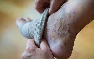 Varicose Veins Treatment in Jaipur
