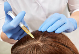 PRP Hair Treatment for Thinning Hairlines