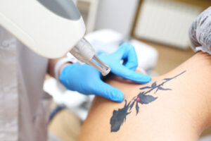 PicoSure Laser Technology Explained