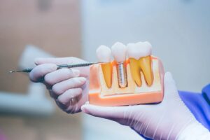 Restore Your Smile with Dental Implant Houston TX Solutions: Teeth Implants and Denture Implants in Houston