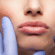 Russian Lip Fillers in Dubai