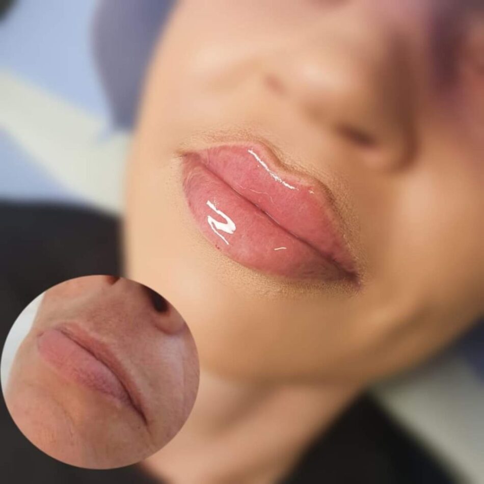 Russian Lip Fillers vs. Classic Lip Fillers, Which Is Better for You?
