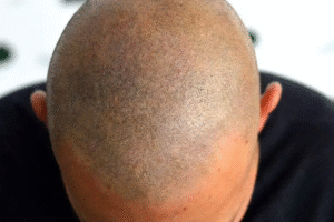 Scalp Micropigmentation in Dubai