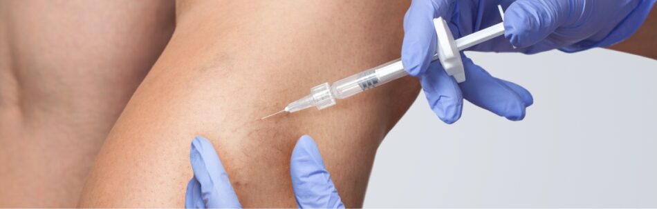 Sclerotherapy Quick and Effective Procedure