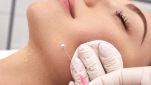 Silhouette Soft Thread Lift in Dubai