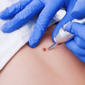 Skin Lesion Removal That Fits Your Lifestyle