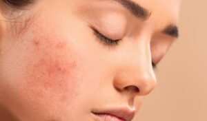 Skin Pigmentation Treatment in Islamabad