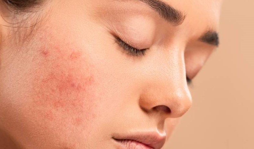 Skin Pigmentation Treatment in Islamabad
