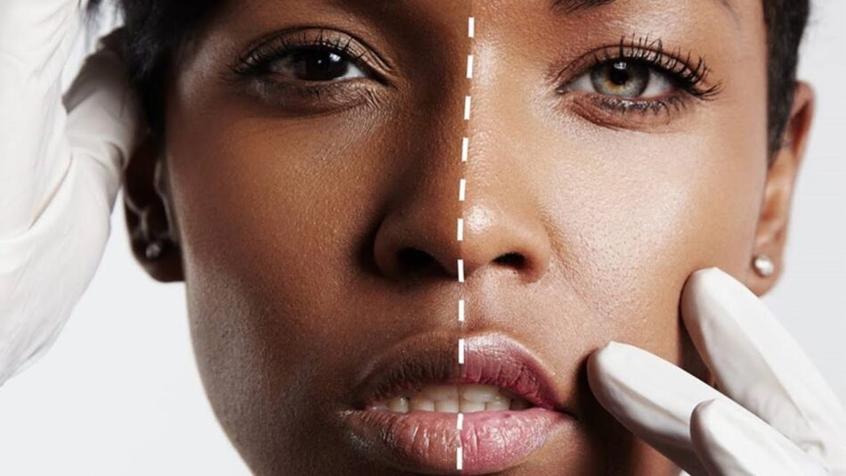 Skin whitening in Islamabad