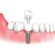 Understanding Dental Implant Cost and Wisdom Teeth Removal in Franklin, KY