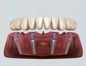 Understanding the Cost of Dental Implants Pearl MS and Exploring Full Arch Implant Solutions