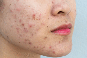 What Acne Treatment Clears Skin Without Dryness?