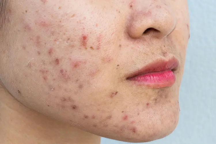 What Acne Treatment Clears Skin Without Dryness?