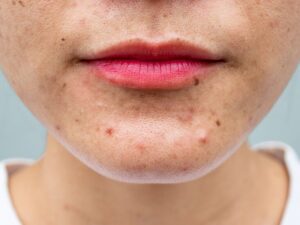 What Acne Treatment Offers Quick Visible Change