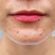 What Acne Treatment Offers Quick Visible Change