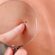 What Is the Best Skin Tag Removal Method?