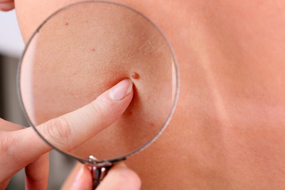 What Is the Best Skin Tag Removal Method?